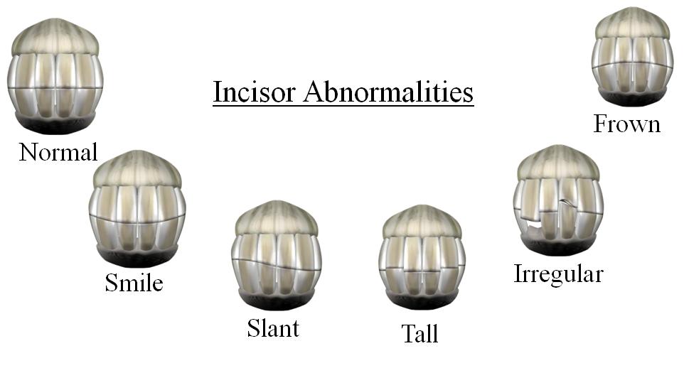 Incisor Abnormalities